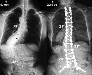 Pre and Post-Op X-Rays