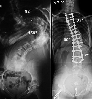 Pre and Post-Op X-Rays