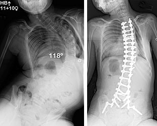 Pre and Post-Op X-Rays