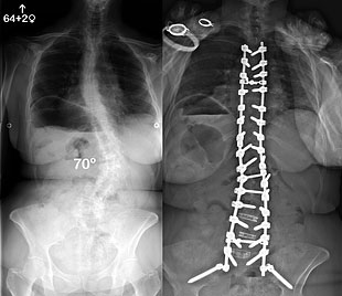 Pre and Post-Op X-Rays