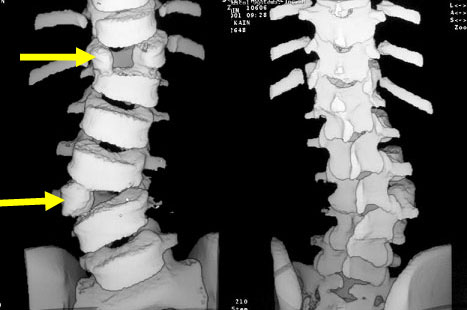 Three-dimension CT scan of the spine showing a hemi vertebra (partially formed vertebra) at T-12 and between L-2 and L-3 vertebrae