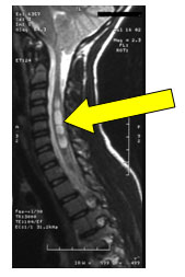 Side-view MRI showing syrinx (abnormal collection of fluid within the spinal cord) in a 7-year-old boy with a 30<sup>o</sup> neuromuscular scoliosis.