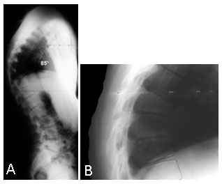 Scheuermann's disease