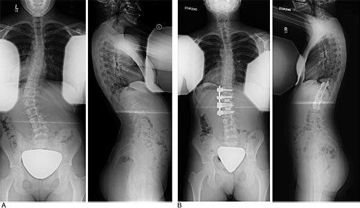 Anterior approach