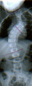 Complex congenital spine deformity.