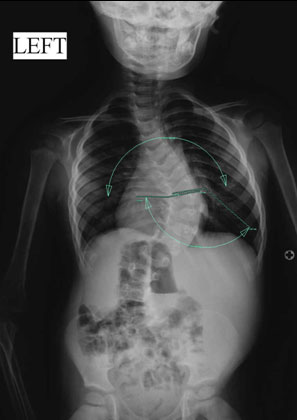 The degree of scoliosis and the Mehta rib vertebral angle are measured in infantile scoliosis