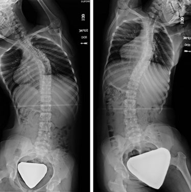 X-rays can be taken in which the patient lays on the table and bends to the right and then to the left to assess the flexibility of the spine