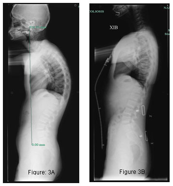 hyperkyphosis