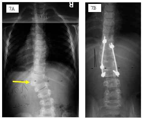 Large progressive hemi vertebra between T-12 and L-1