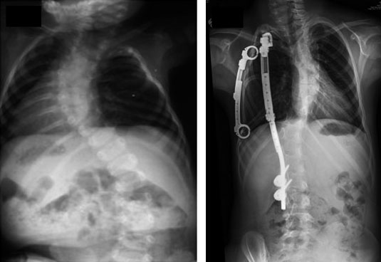 mid thoracic spine multiple hemi vertebrae