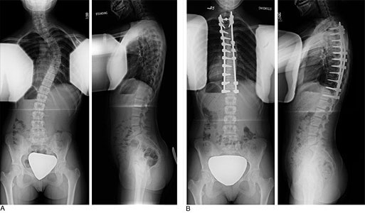 Posterior approach