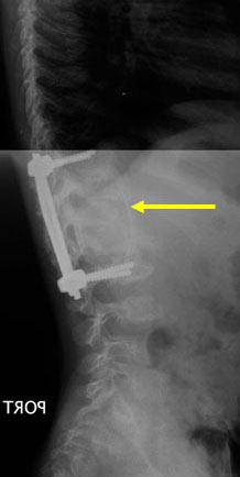 Postoperative x-ray of the instrumentation and fusion of the spine anteriorly and posteriorly.