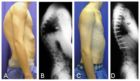 Preoperative photo of patient with severe kyphosis secondary to Scheuermann's disease.