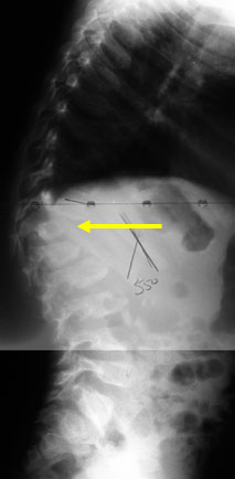 Preoperative x-ray of a failure of formation kyphotic spinal deformity.