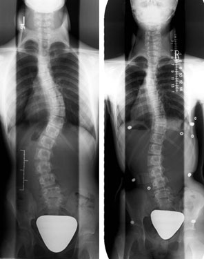 Radiographs performed without (left) and with the brace on (right)