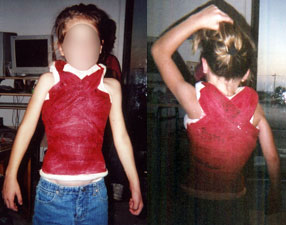 Front and back views of a child in a cast for scoliosis.