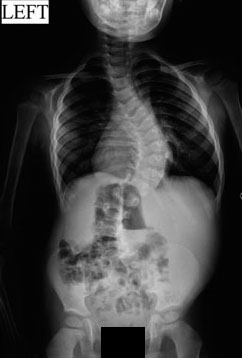 Four year old male with now a sixty degree progressive curve despite brace wear.