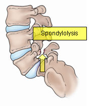 Spondylolysis