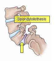 Spondylolysis