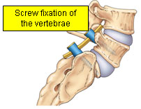 Screw flixation of th vertebrae