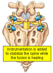 Instrumentation is added to stabilize the spine while the fusion is healing