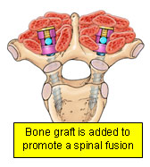 Bone graft is added to promote a spinal fusion