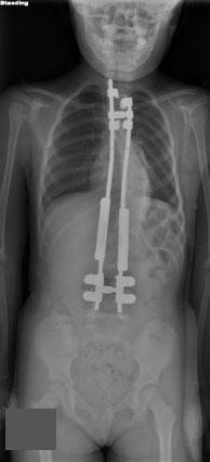 Two telescoping growth rods have been inserted and will be relengthened every six months to maintain the correction.