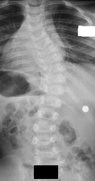 Two year old white male with thirty degree infantile scoliosis.