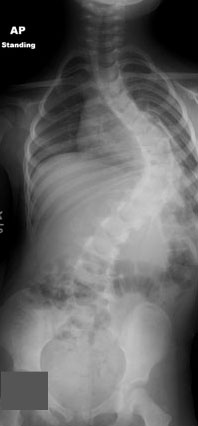 Severe right thoracic juvenile scoliosis.